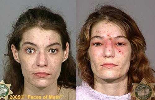 Фото наркоманов до и после приема наркотиков