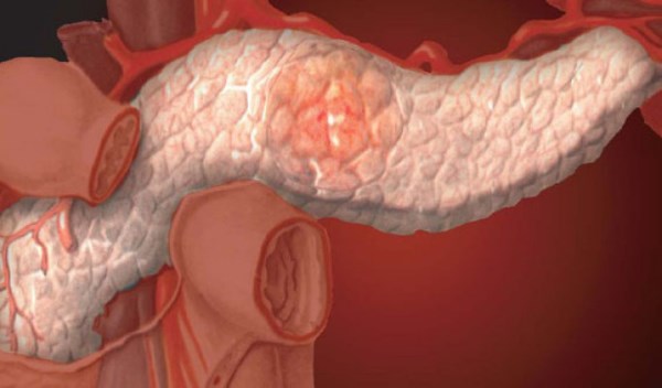 Заболевания поджелудочной железы: причины и симптомы